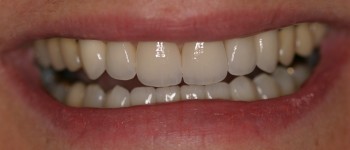 Tooth Crown After