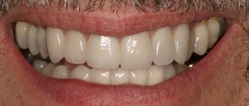 tooth Crown After
