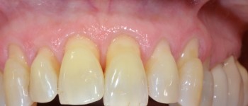 Connective Tissue Grafting Before