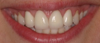Gum Revision & Crowns After Photo
