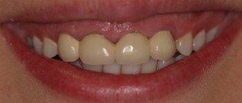 Gum Revision & Crowns Before Photo