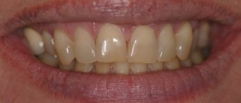 Before Porcelain Dental Veneers Photo