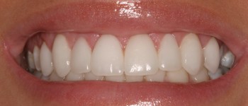 Porcelain Dental Veneers After Photo