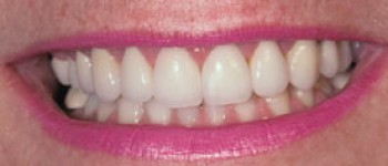 Porcelain Dental Veneers After Photo