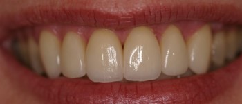 Porcelain Dental Veneers After Photo