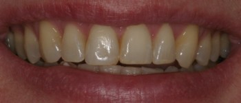 Before Porcelain Dental Veneers Photo