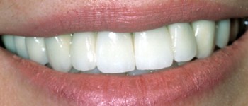 Dental Implants After Photo