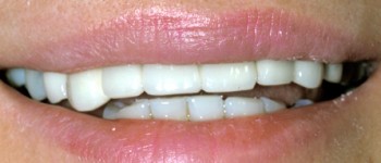 Photo Before Dental Implants