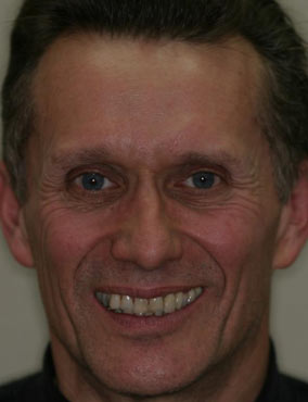 David Before cosmetic dentistry and in bad lighting