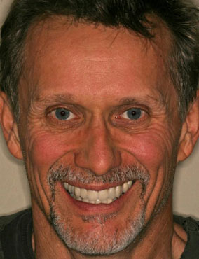 David After cosmetic dentistry