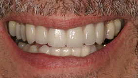 David After cosmetic dentistry