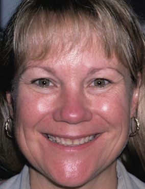 Denise Before cosmetic dental procedures