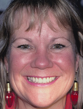 Denise After cosmetic dentistry with Dr James Miller