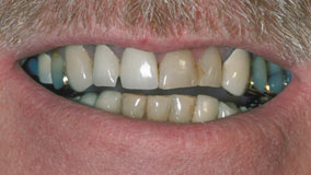 Gary Before Full Mouth Restoration with Dental Implants