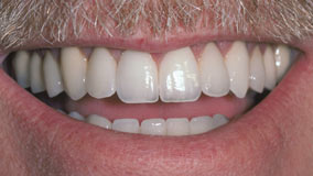 Gary After Full Mouth Restoration with Dental Implants