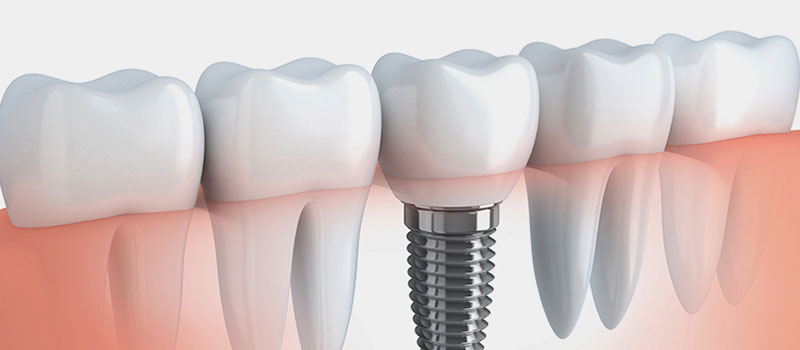 Dental Implant explained in a picture